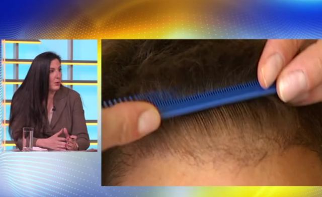 Posle korone može da vam opada i kosa, ali evo zašto ne treba da brinete VIDEO